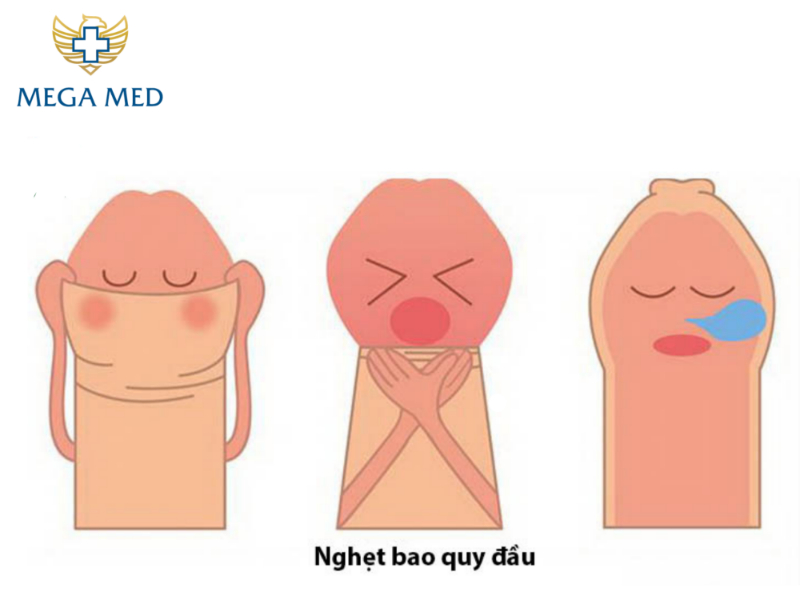 Hiện tượng nghẹt bao quy đầu